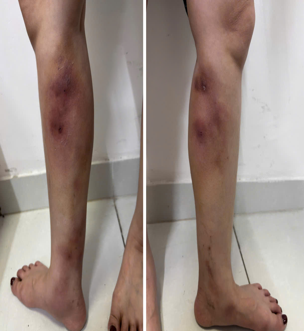 Cận cảnh đôi chân của cô gái 29 tuổi sau tiêm filler thẳng chân tại nhà- Ảnh 2.