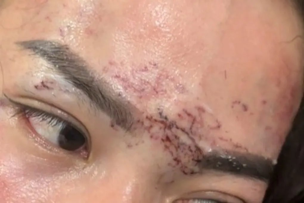 14-1773454464-ca-mau-hai-lan-hoan-xu-vu-an-danh-ghen-kinh-hoang-dung-may-phun-xam-huy-hoai-khuon-mat-tinh-dich