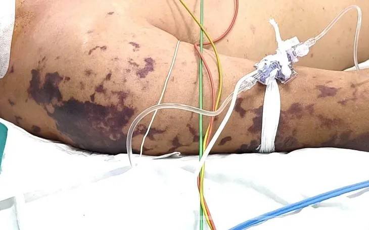 24-1774325207-viem-nao-mo-cau-bung-phat-tai-nhieu-dia-phuong-da-co-nguoi-tu-vong-canh-bao-can-benh-co-the-gay-tu-vong-trong-24-gio