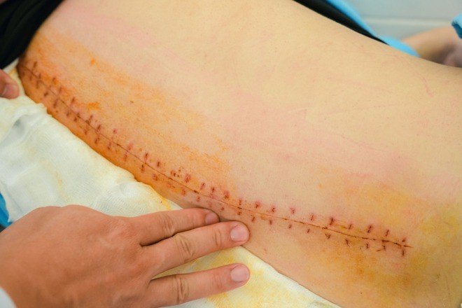 Soi gương thấy lưng có dấu hiệu lạ, cô gái 18 tuổi sốc khi biết cột sống đã cong 53 độ - Ảnh 3.