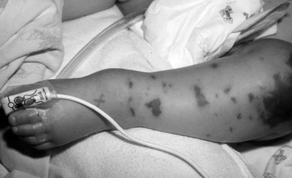 15-1776221070-canh-bao-benh-nao-mo-cau-gia-tang-da-ghi-nhan-4-ca-tu-vong-tai-dong-nam-bo