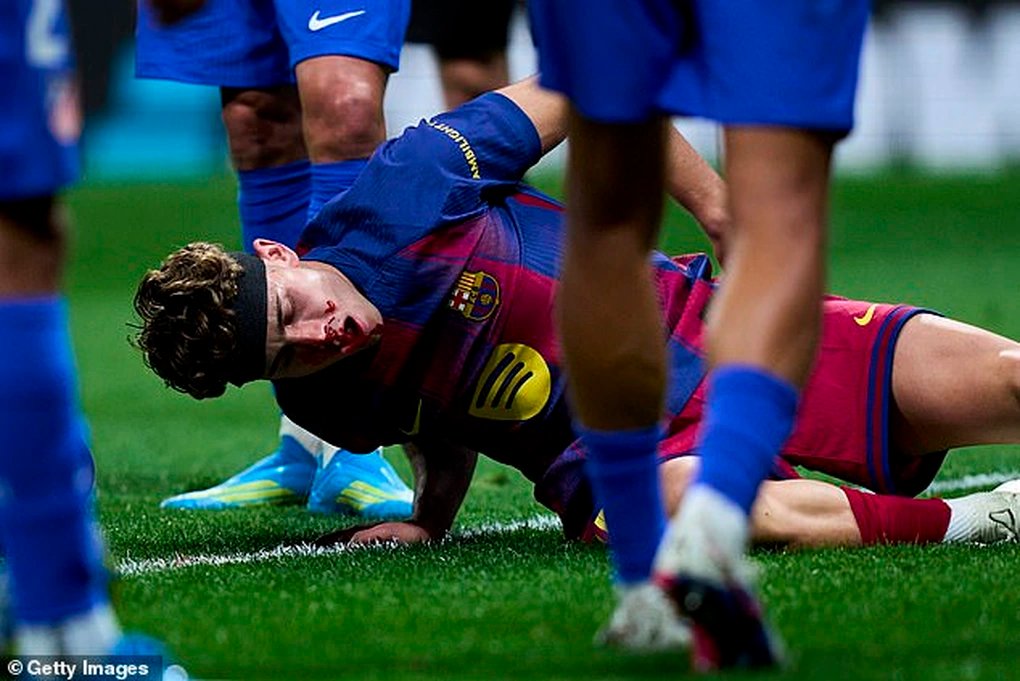 15-1776227296-sao-barcelona-do-mau-sau-khi-lanh-tron-gam-giay-vao-mat