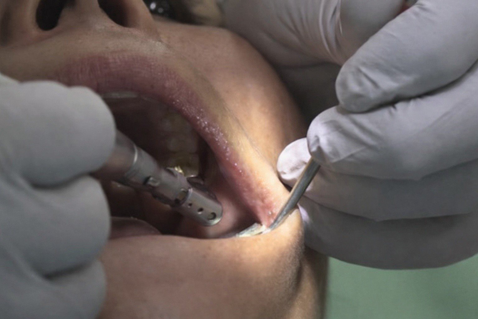 21-1776738304-phat-hien-nhiem-hiv-sau-con-sot-keo-dai-nam-shipper-bang-hoang-toi-chi-di-kham-rang-thoi-ma