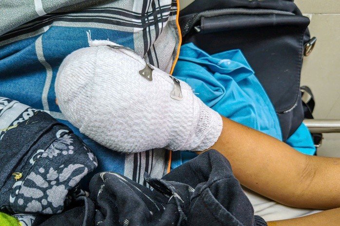 Cháu bé bị dập bàn tay nghi do điện thoại nổ lúc sạc pin - Ảnh 2.