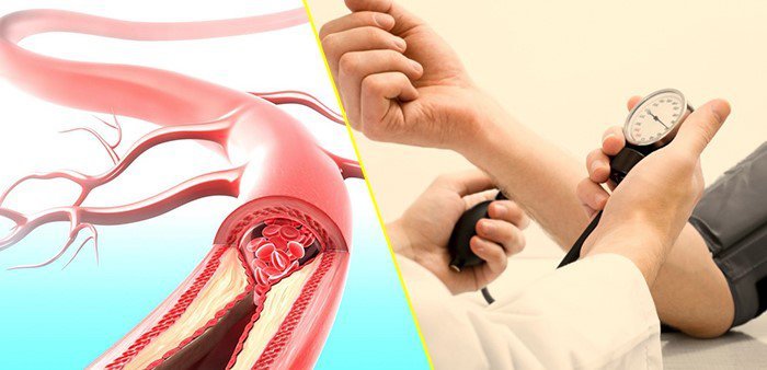 Lưu ý quan trọng khi điều trị tăng huyết áp ở người cao tuổi