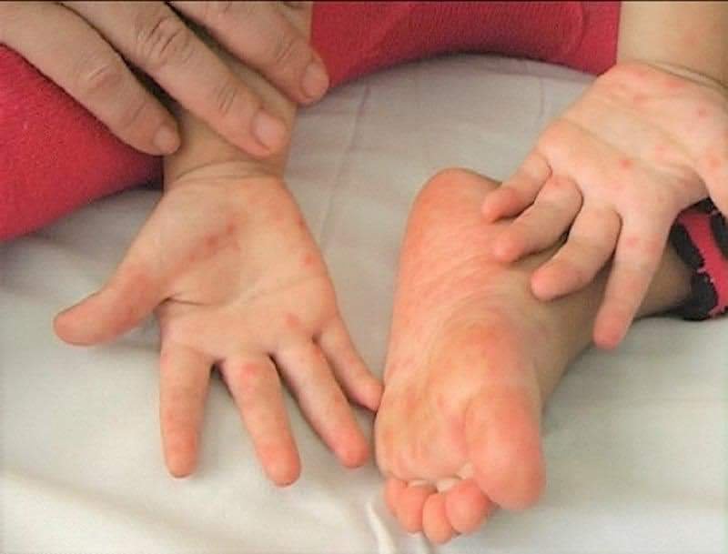 Bệnh tay chân miệng – Những kiến thức cơ bản cha mẹ cần biết - Bệnh viện Bãi Cháy