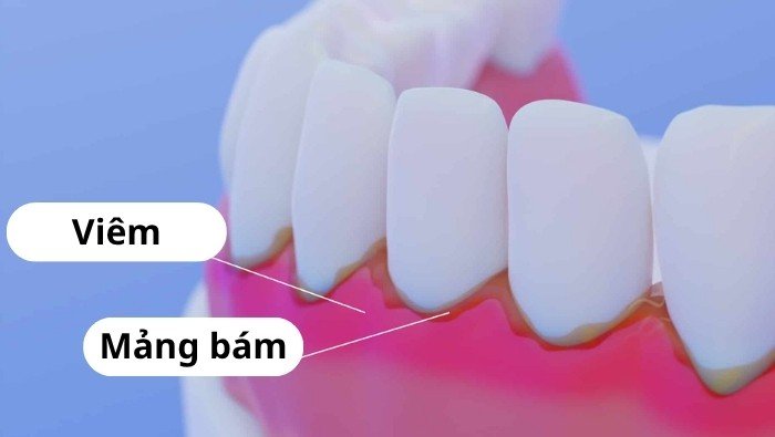 Mảng bám tích tụ lâu ngày hóa cứng thành cao răng là nguyên nhân hàng đầu gây viêm chân răng