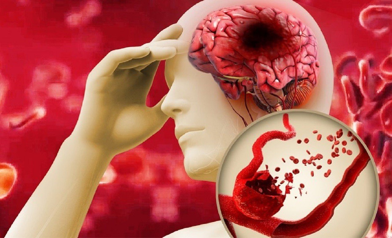 Ai nên tầm soát đột quỵ?