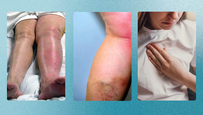 Sưng đau bắp chân, da đổi màu và đau ngực là những dấu hiệu cảnh báo cục máu đông thường gặp