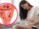 Lạc nội mạc tử cung: Vì sao bệnh thường bị phát hiện muộn?
