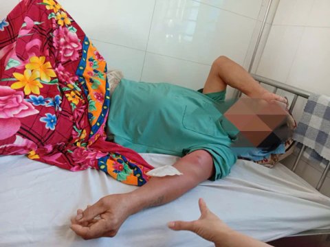 Thanh Hóa liên tiếp phát hiện bệnh nhân mắc giun rồng do uống nước suối